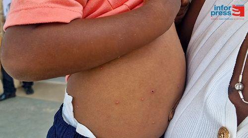 Boa Vista: Delegacia de Saúde confirma surto de varicela e alerta para casos de "mão-pé-boca"