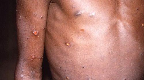 Cabo Verde reactivates rapid response plan for possible detection of the Mpox virus
